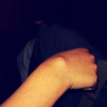 Precious's cyst